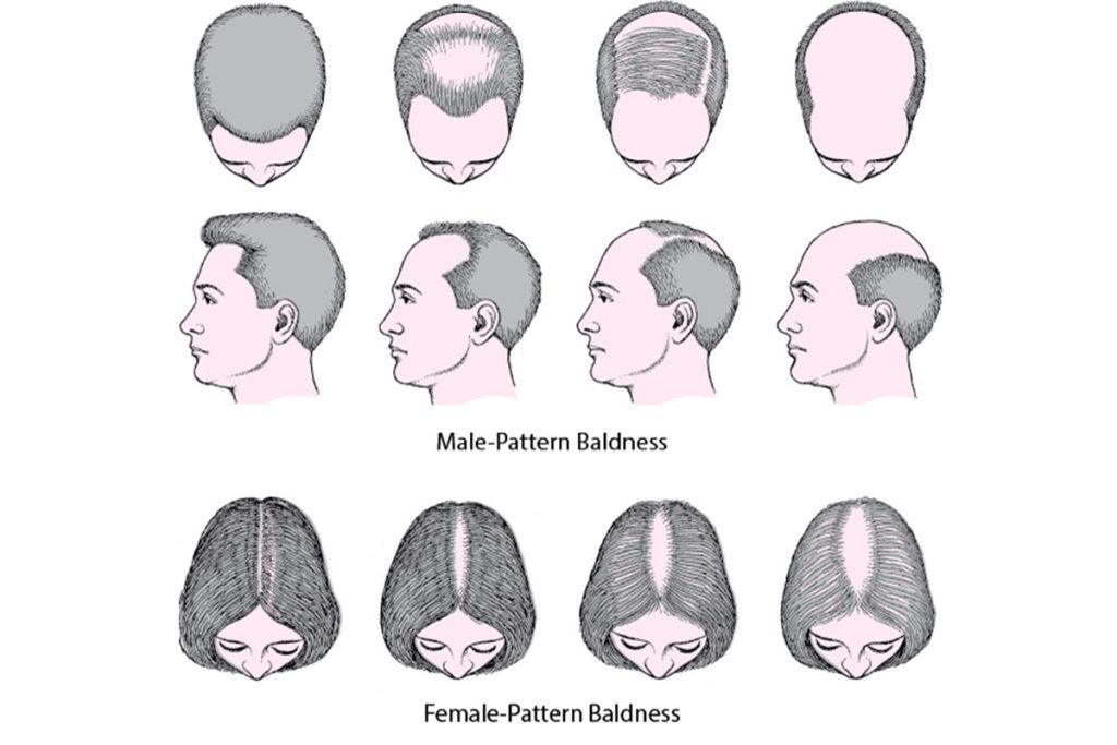Male vs female pattern hair loss compared