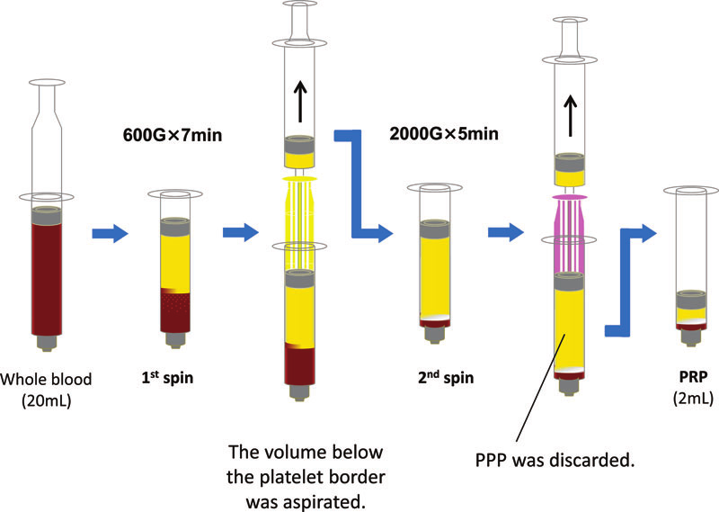 PRP preparation in a two-step centrifugation setup