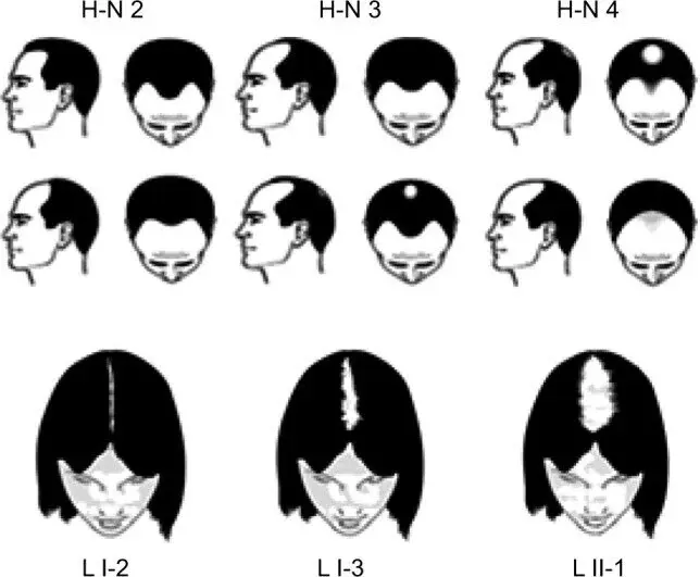 Hamilton–Norwood and Ludwig scales for pattern hair loss